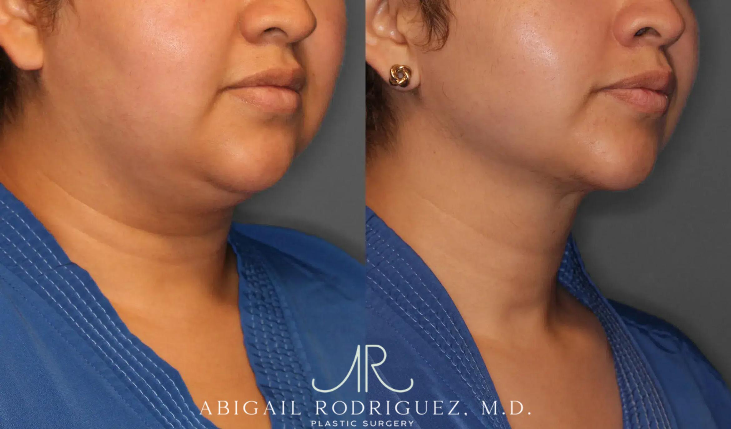Before & After Neck Liposuction Case 259393 View 5 View in Houston, TX
