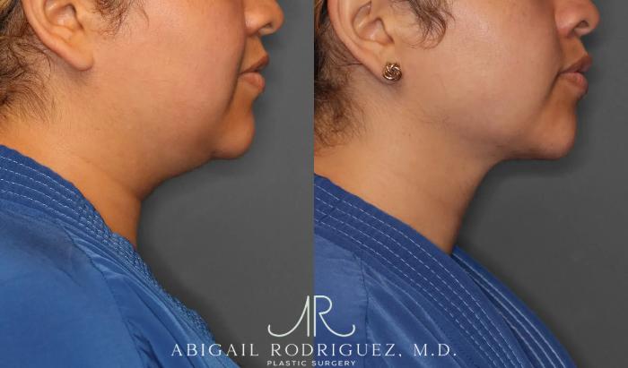 Before & After Neck Liposuction Case 259393 View 6 View in Houston, TX