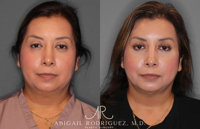 Before & After Neck Liposuction Case 259513 View 1 View in Houston, TX