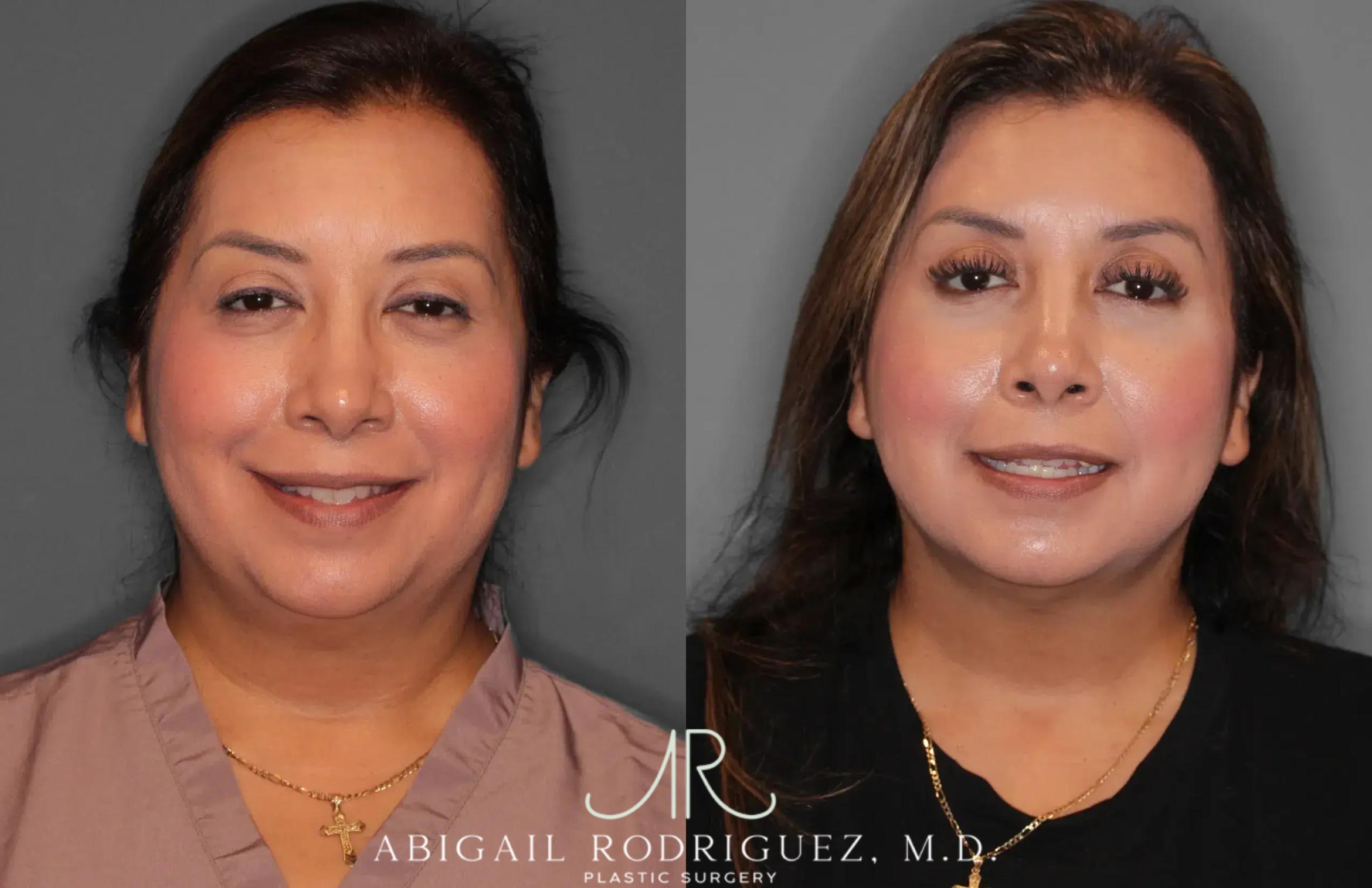 Before & After Neck Liposuction Case 259513 View 2 View in Houston, TX