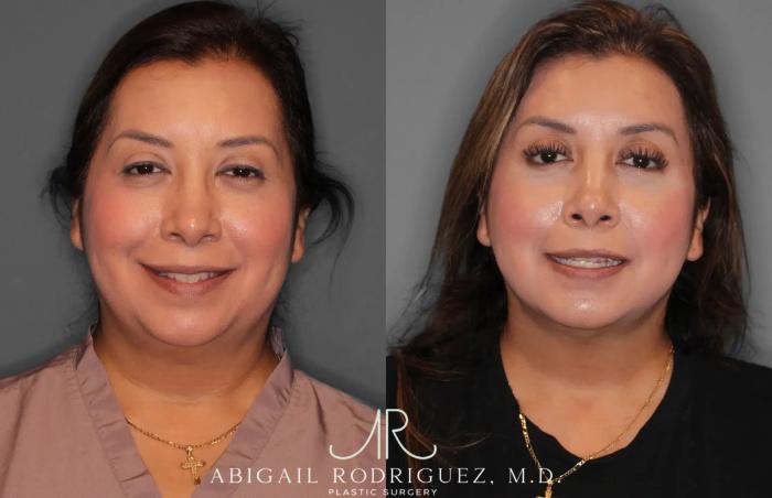 Before & After Neck Liposuction Case 259513 View 2 View in Houston, TX