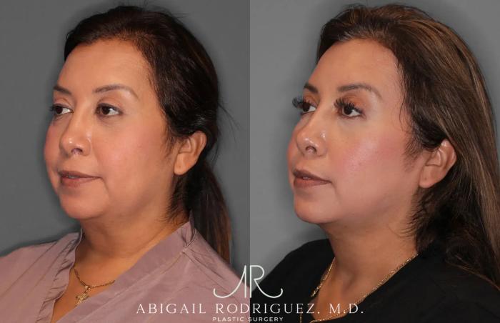 Before & After Neck Liposuction Case 259513 View 3 View in Houston, TX