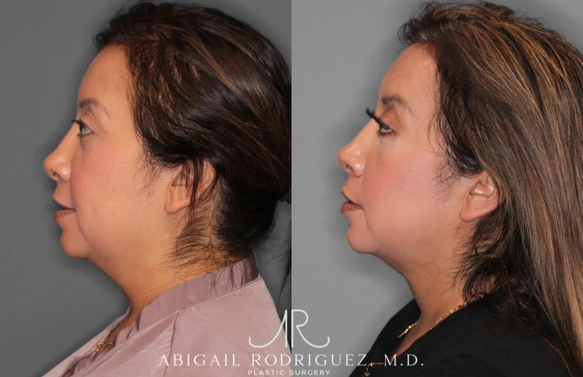 Before & After Neck Liposuction Case 259513 View 4 View in Houston, TX
