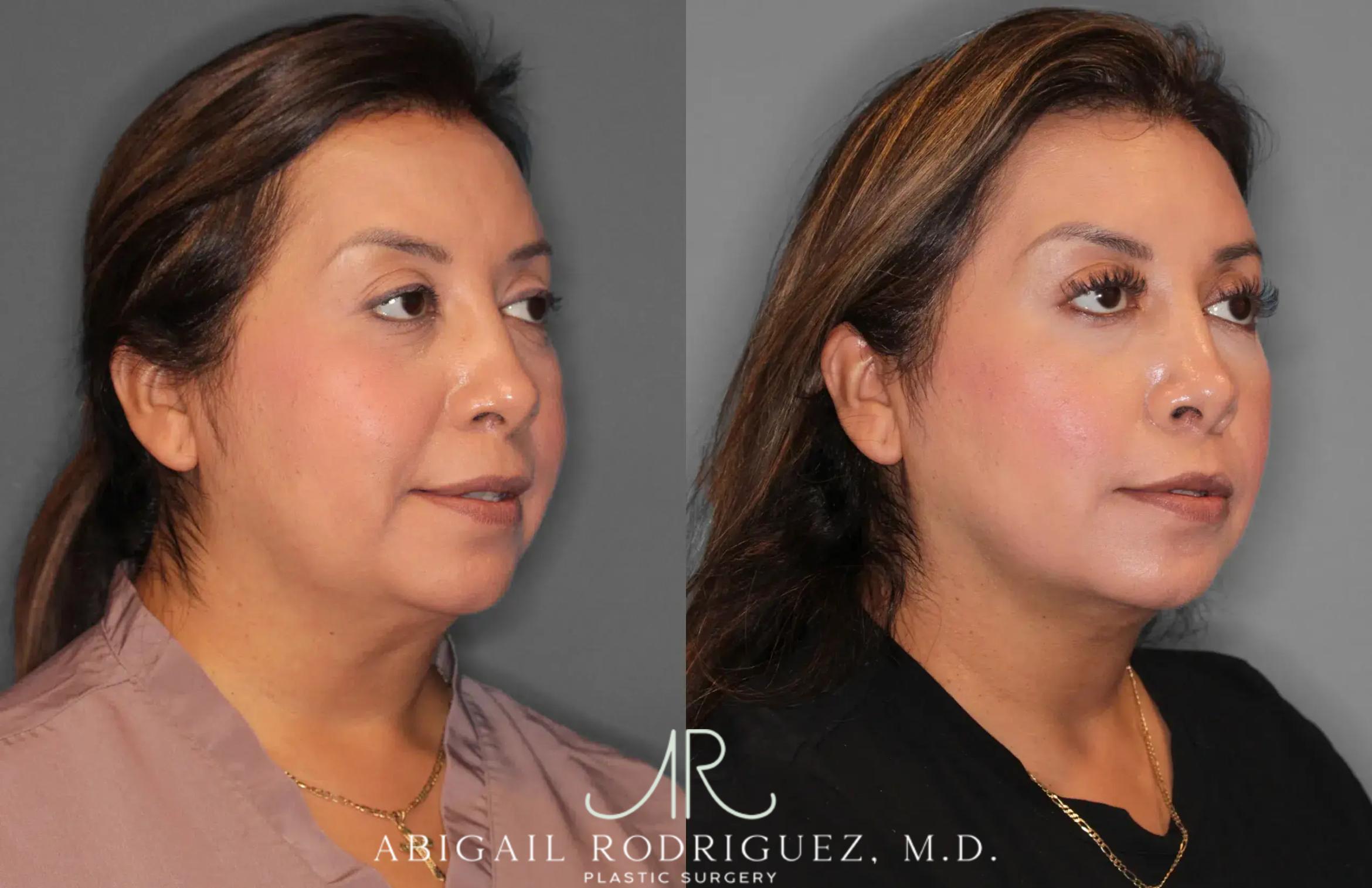 Before & After Neck Liposuction Case 259513 View 5 View in Houston, TX