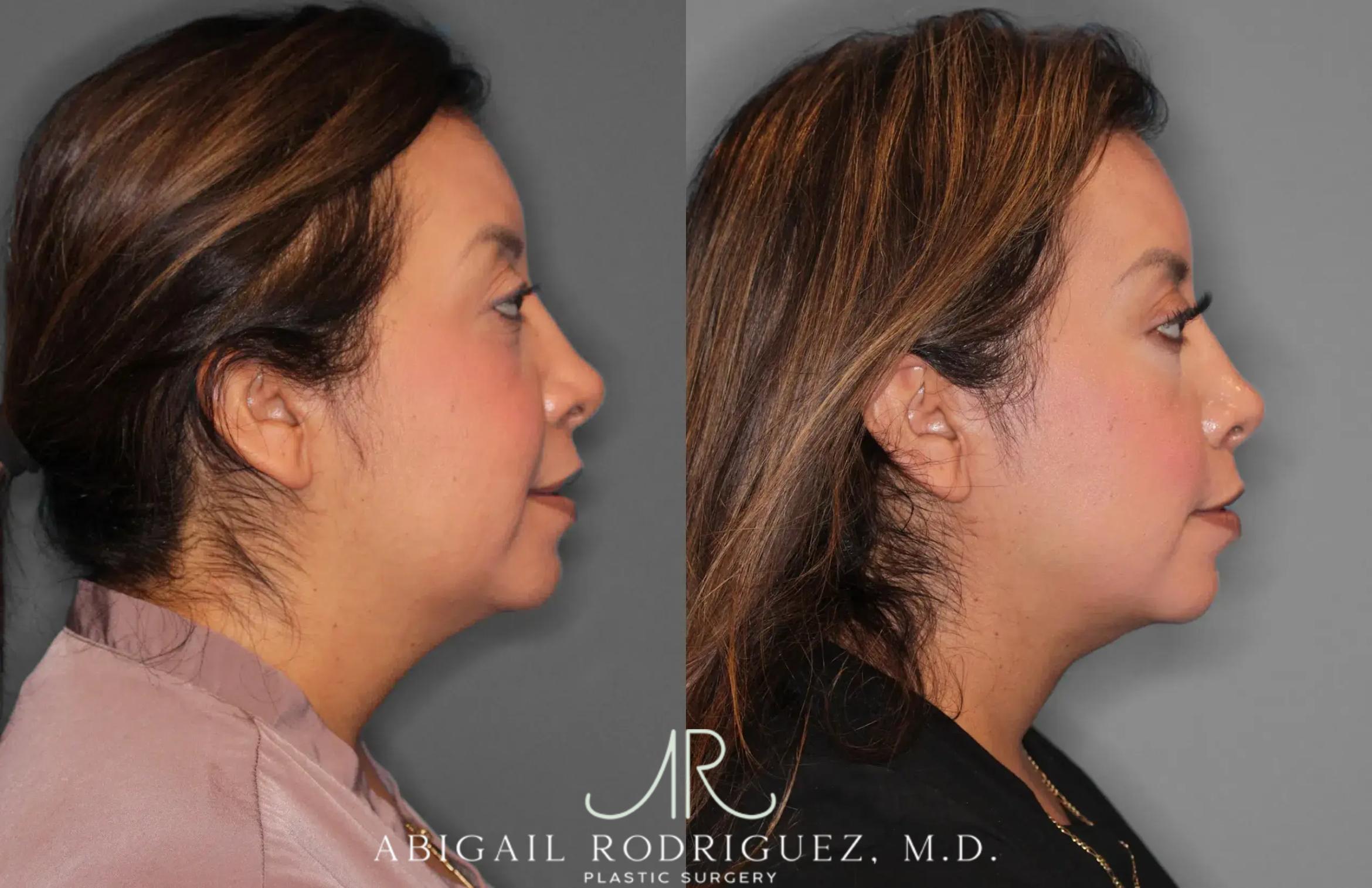 Before & After Neck Liposuction Case 259513 View 6 View in Houston, TX