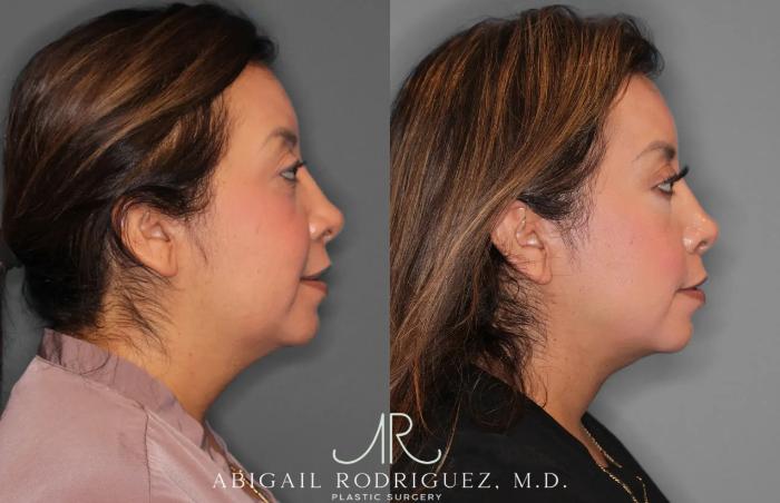 Before & After Neck Liposuction Case 259513 View 6 View in Houston, TX