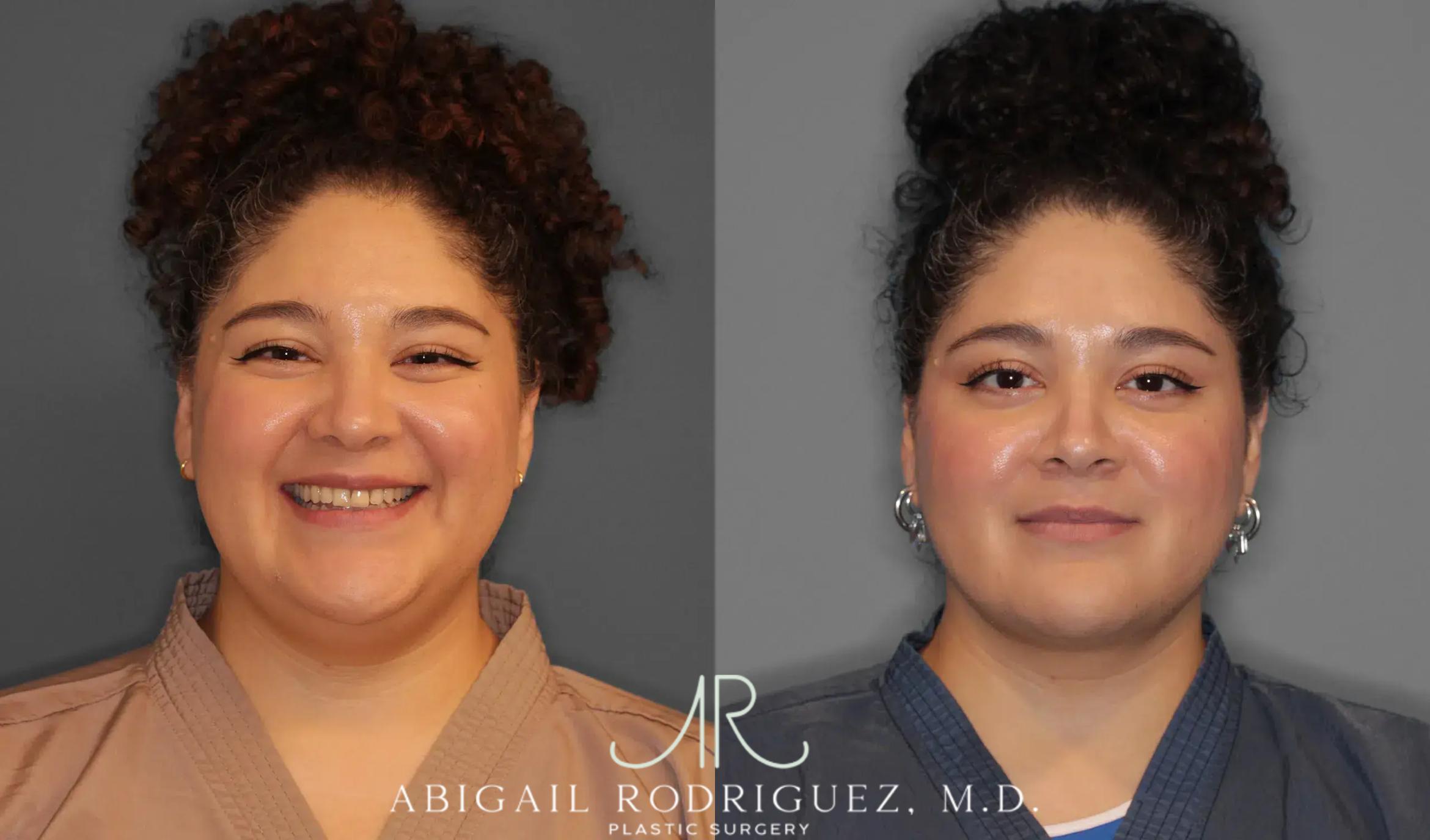 Before & After Neck Liposuction Case 259543 View 1 View in Houston, TX