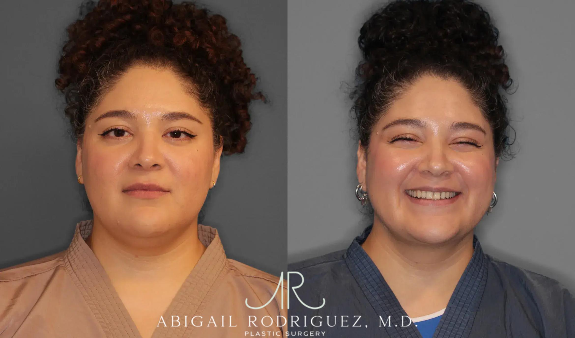 Before & After Neck Liposuction Case 259543 View 2 View in Houston, TX