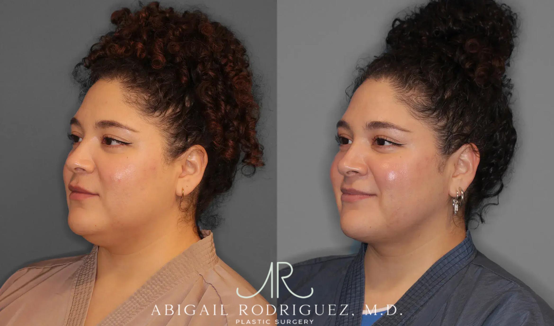 Before & After Neck Liposuction Case 259543 View 3 View in Houston, TX