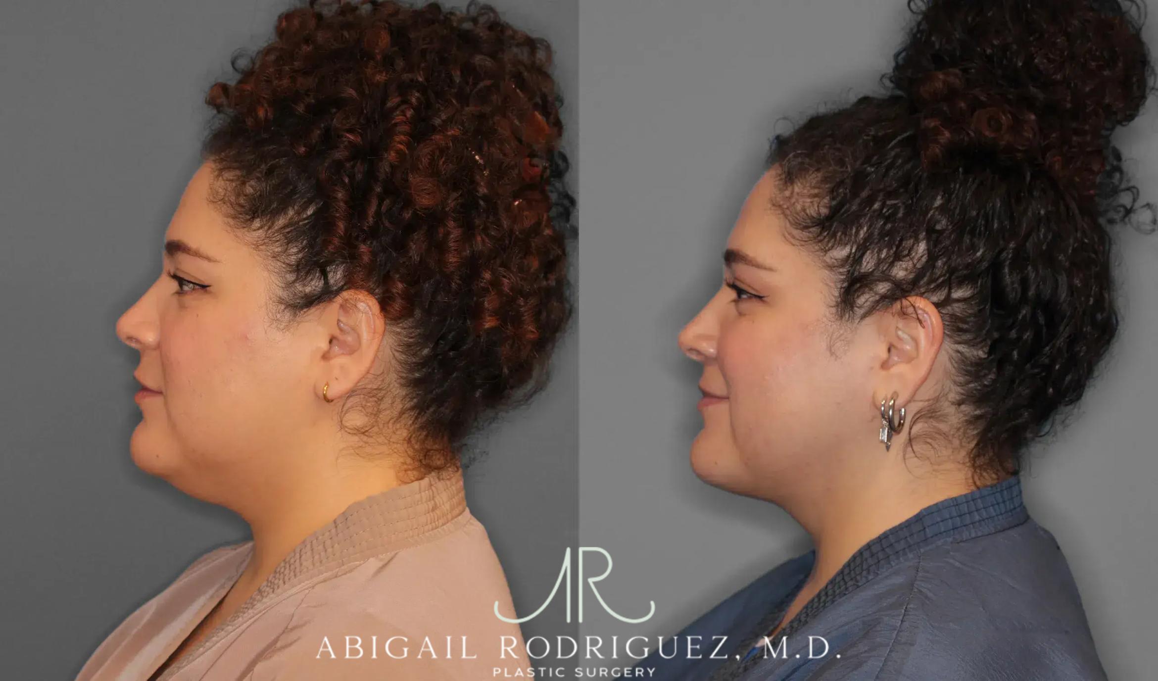 Before & After Neck Liposuction Case 259543 View 4 View in Houston, TX