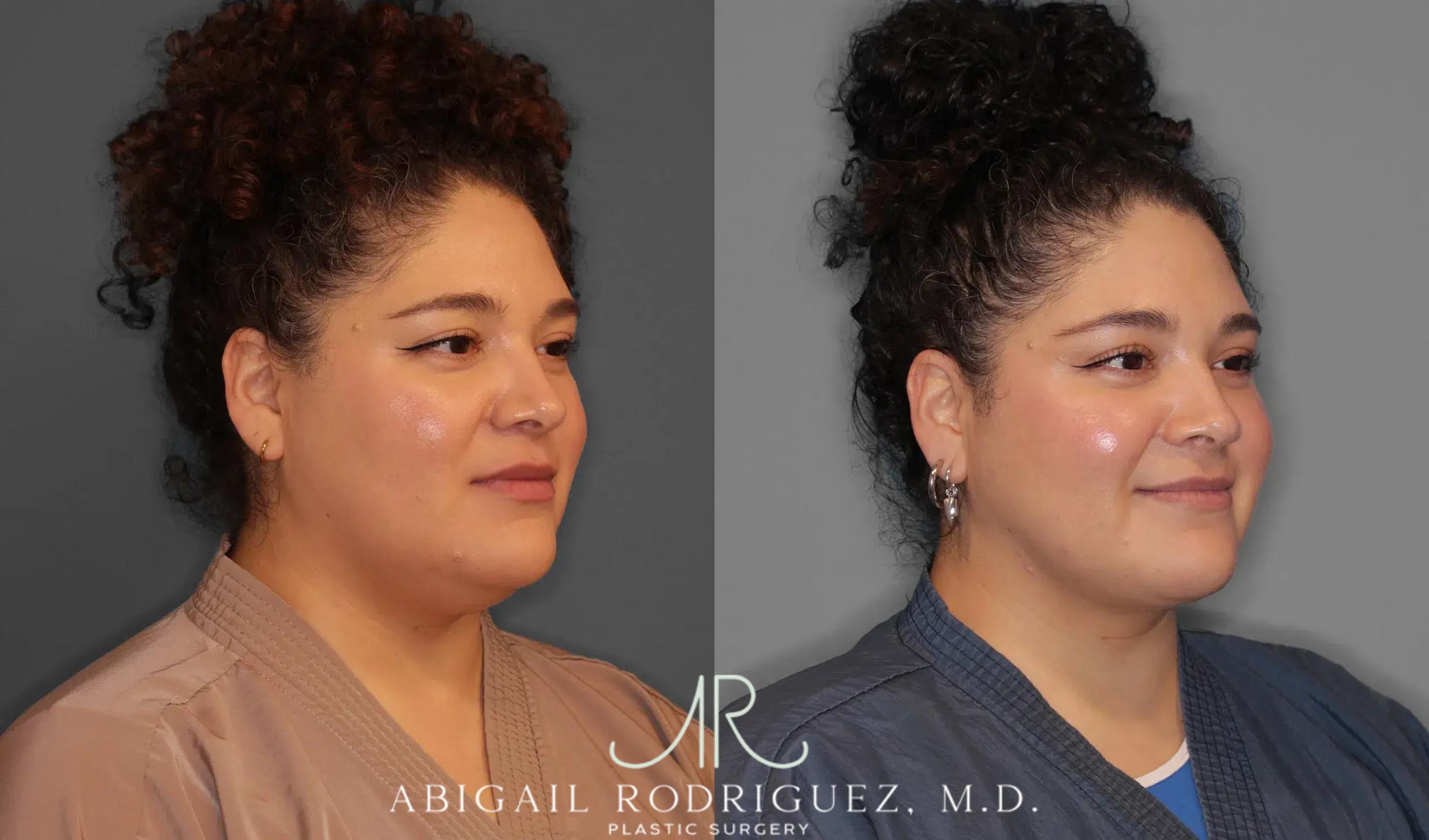 Before & After Neck Liposuction Case 259543 View 5 View in Houston, TX