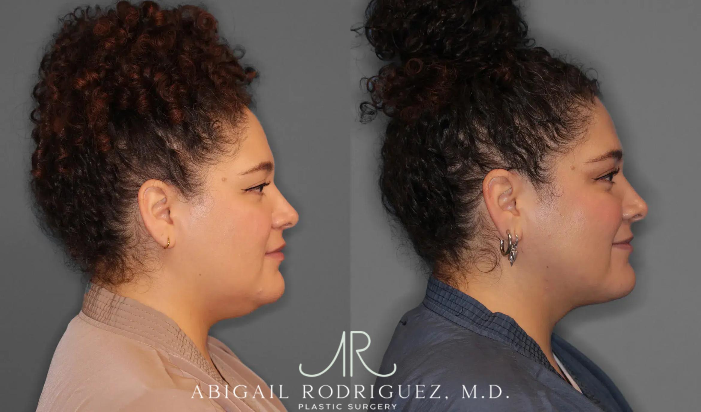 Before & After Neck Liposuction Case 259543 View 6 View in Houston, TX