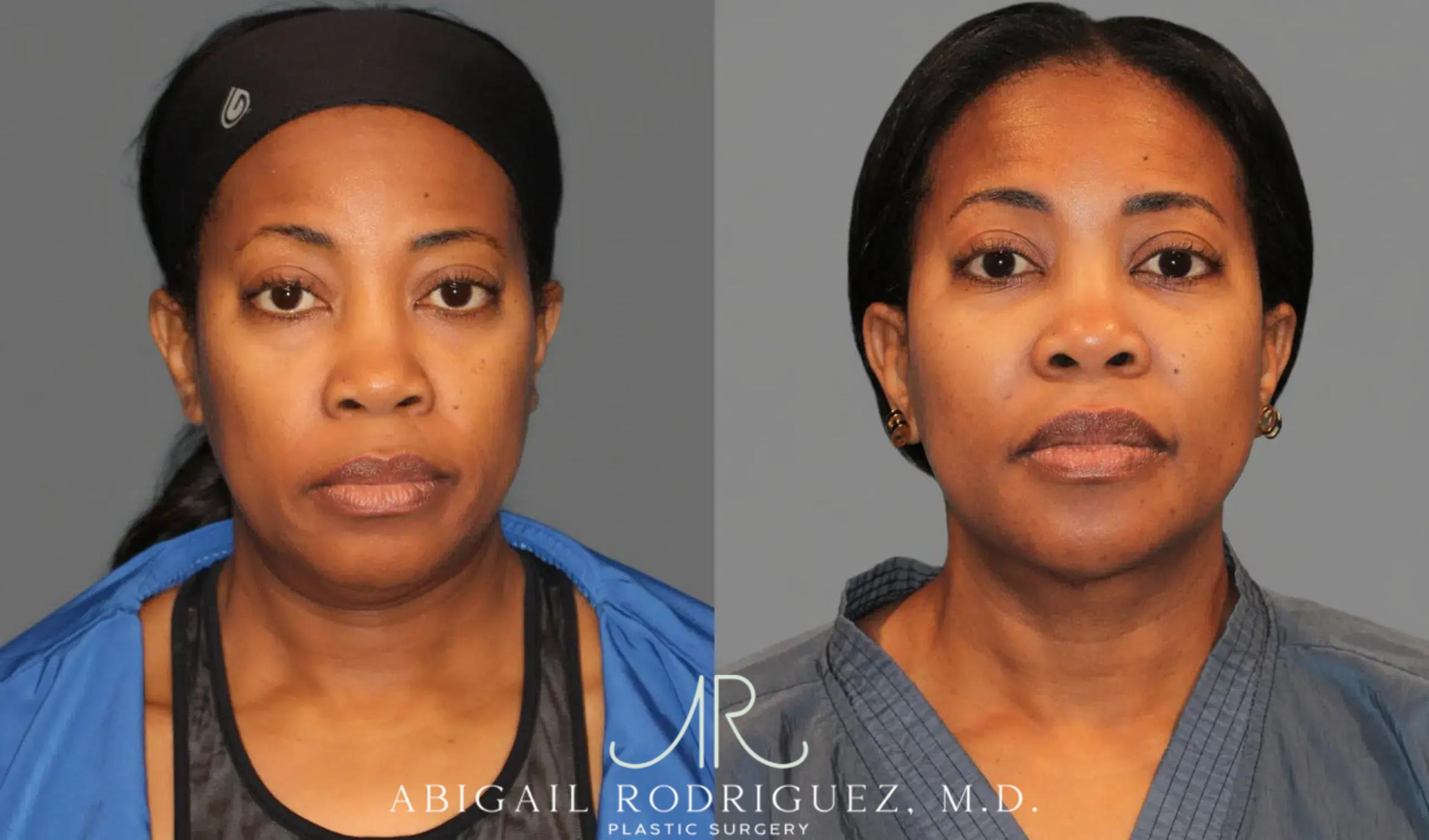 Before & After Neck Liposuction Case 345990 View 1 View in Houston, TX