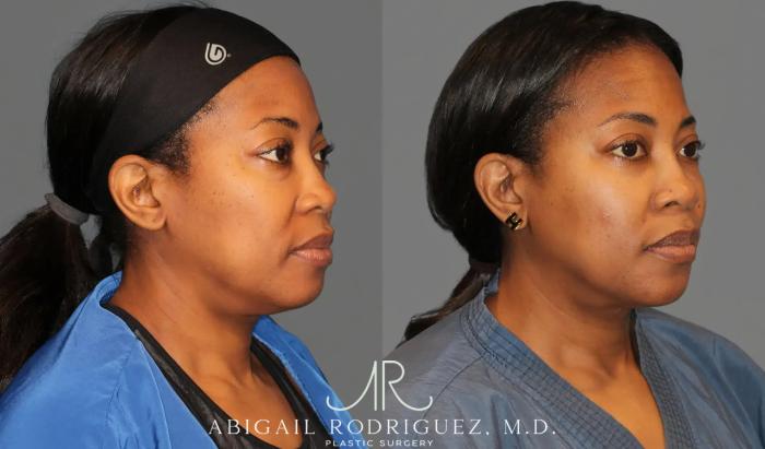 Before & After Neck Liposuction Case 345990 View 3 View in Houston, TX