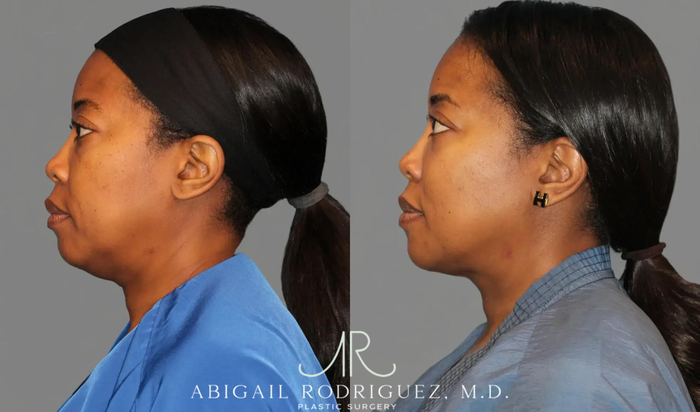 Before & After Neck Liposuction Case 345990 View 6 View in Houston, TX