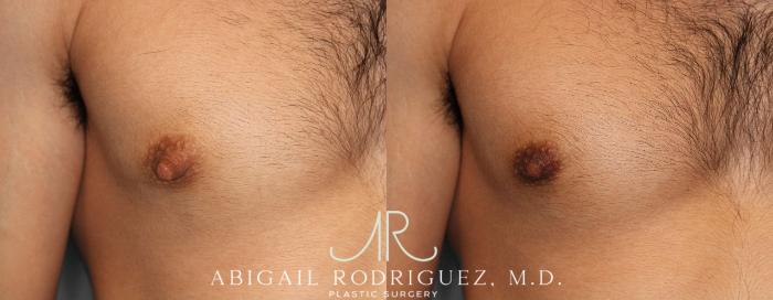 Before & After Nipple Surgery Case 254341 View 1 View in Houston, TX