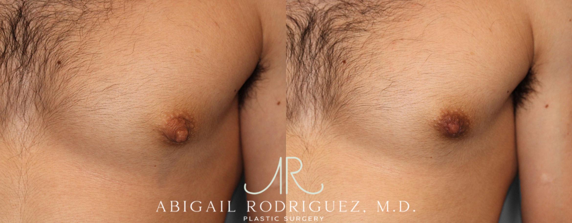 Before & After Nipple Surgery Case 254341 View 2 View in Houston, TX