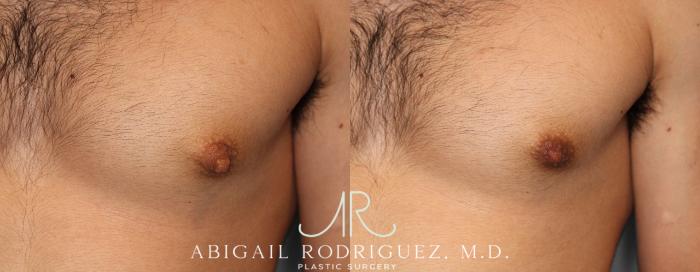 Before & After Nipple Surgery Case 254341 View 2 View in Houston, TX