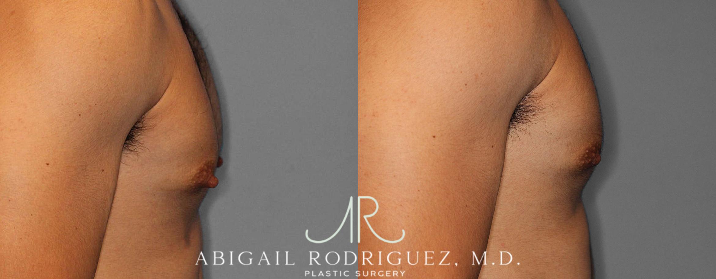 Before & After Nipple Surgery Case 254341 View 3 View in Houston, TX