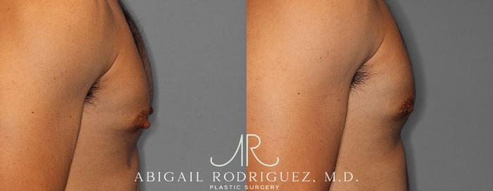 Before & After Nipple Surgery Case 254341 View 3 View in Houston, TX