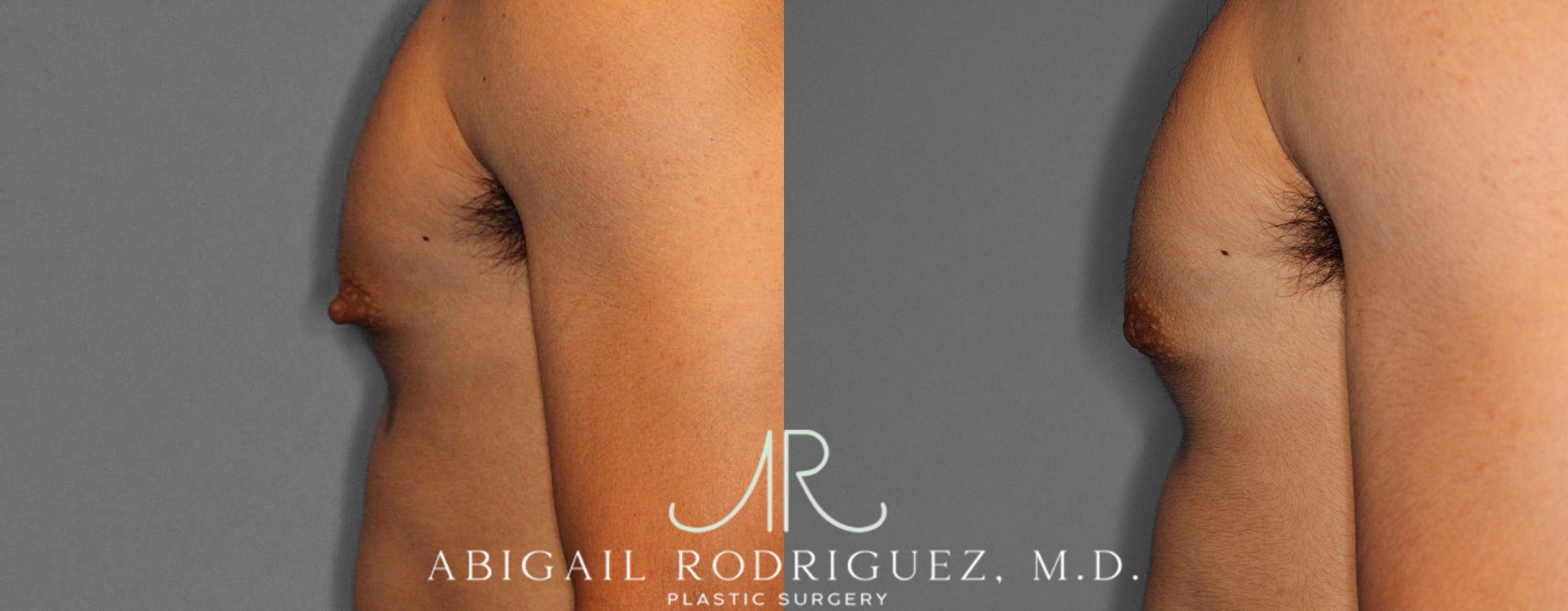 Before & After Nipple Surgery Case 254341 View 4 View in Houston, TX