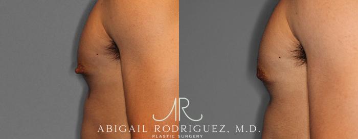 Before & After Nipple Surgery Case 254341 View 4 View in Houston, TX