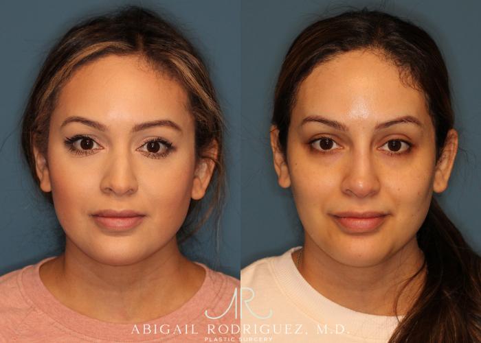 Before & After Non-Surgical Rhinoplasty Case 256524 View 1 View in Houston, TX