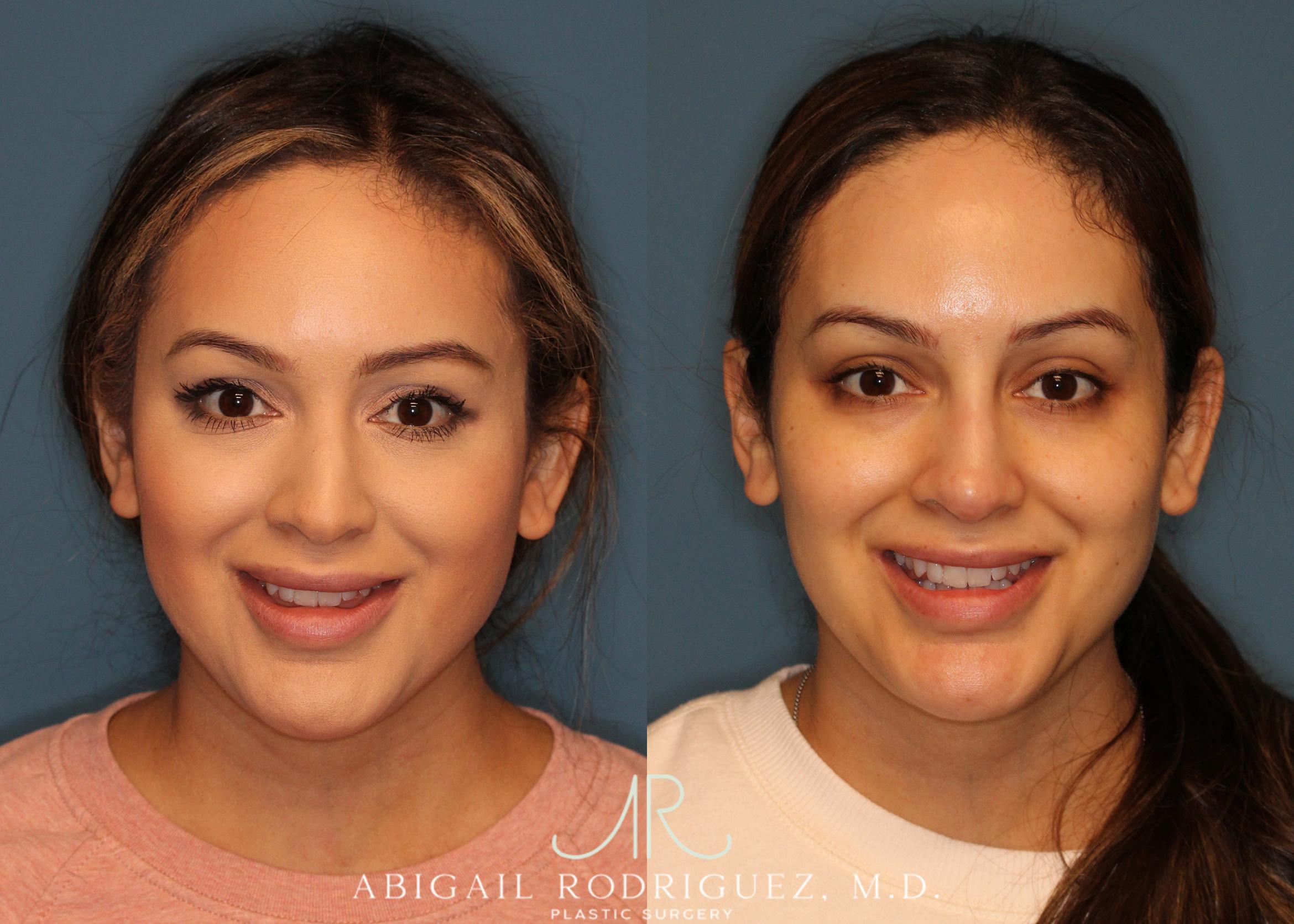 Before & After Non-Surgical Rhinoplasty Case 256524 View 2 View in Houston, TX
