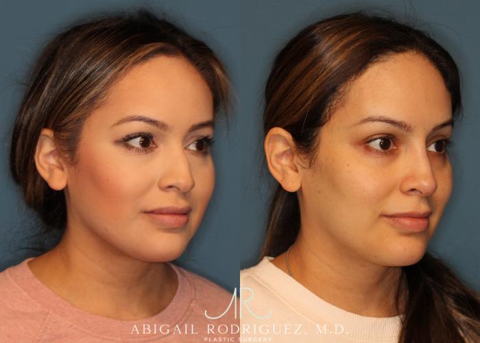 Before & After Non-Surgical Rhinoplasty Case 256524 View 3 View in Houston, TX