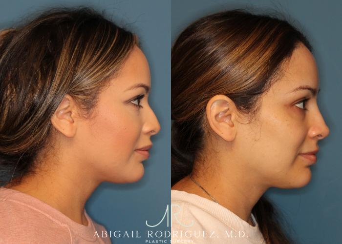 Before & After Non-Surgical Rhinoplasty Case 256524 View 4 View in Houston, TX