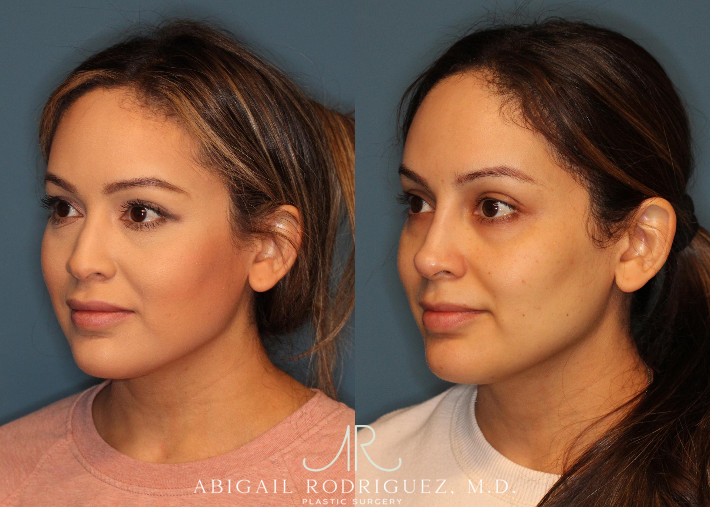 Before & After Non-Surgical Rhinoplasty Case 256524 View 5 View in Houston, TX