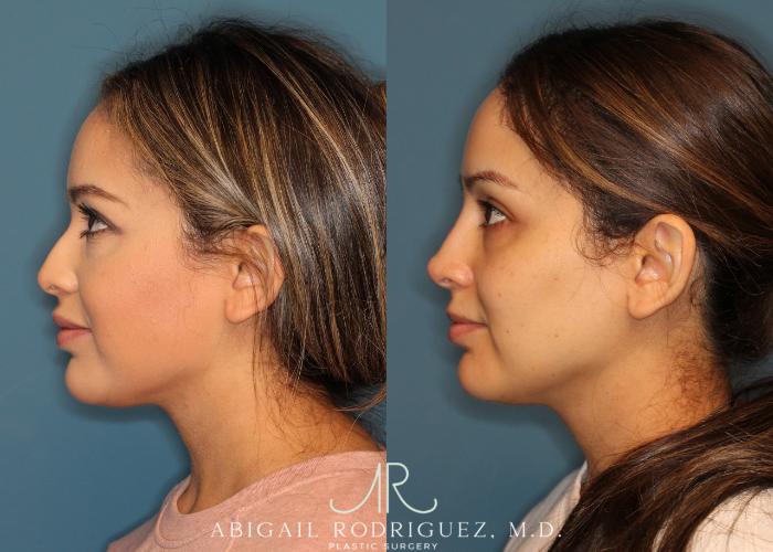Before & After Non-Surgical Rhinoplasty Case 256524 View 6 View in Houston, TX
