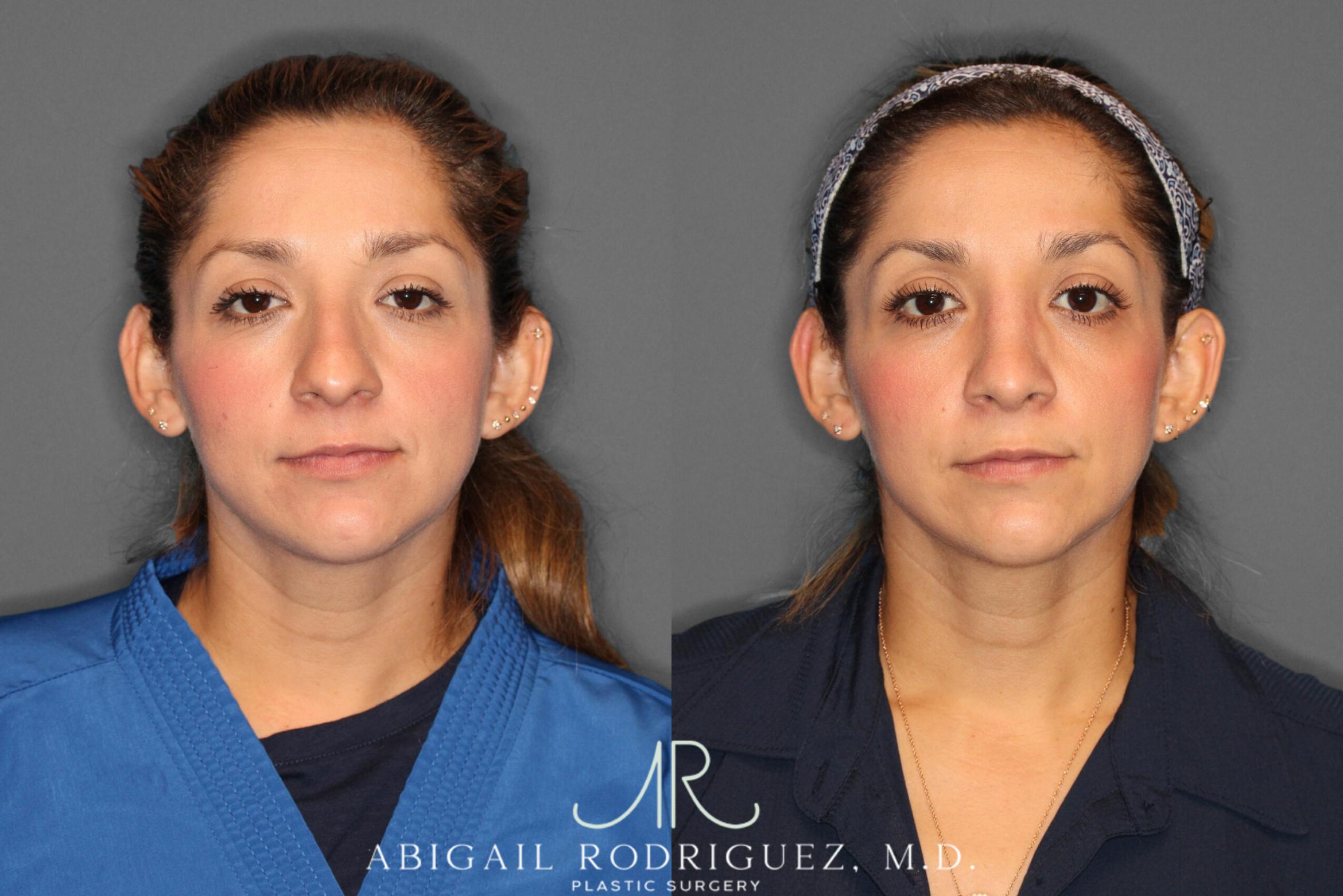 Before & After Non-Surgical Rhinoplasty Case 345991 Front View in Houston, TX