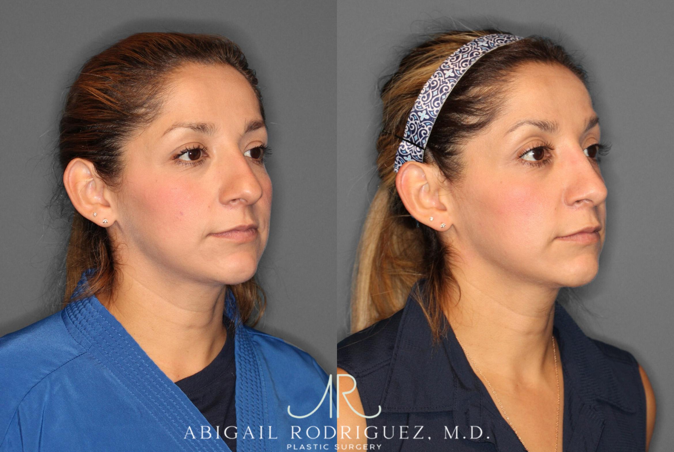 Before & After Non-Surgical Rhinoplasty Case 345991 Right Oblique View in Houston, TX