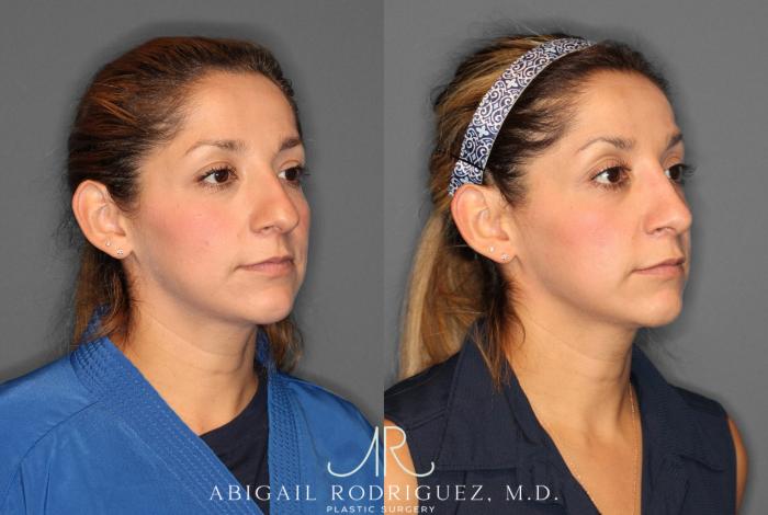 Before & After Non-Surgical Rhinoplasty Case 345991 Right Oblique View in Houston, TX
