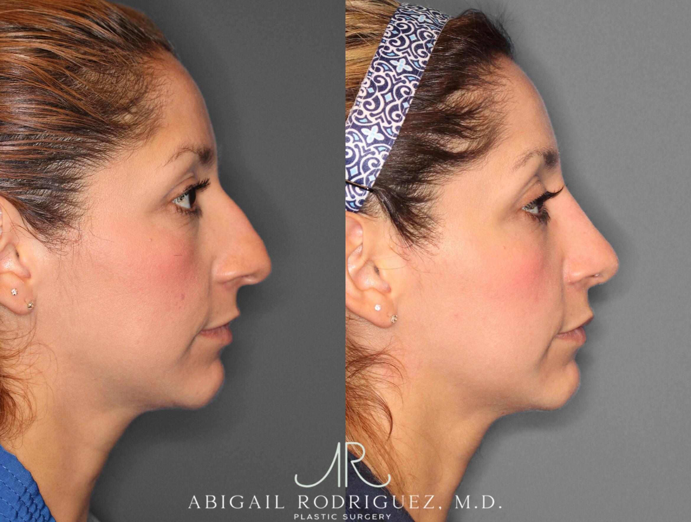 Before & After Non-Surgical Rhinoplasty Case 345991 Right Side View in Houston, TX