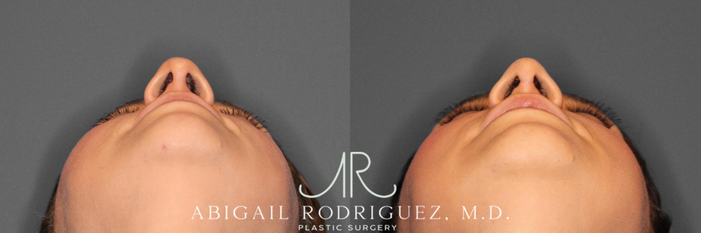 Before & After Non-Surgical Rhinoplasty Case 345991 Under View in Houston, TX