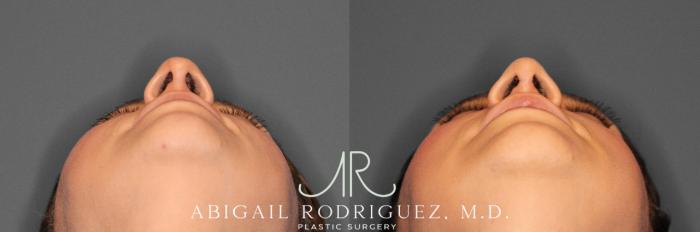 Before & After Non-Surgical Rhinoplasty Case 345991 Under View in Houston, TX