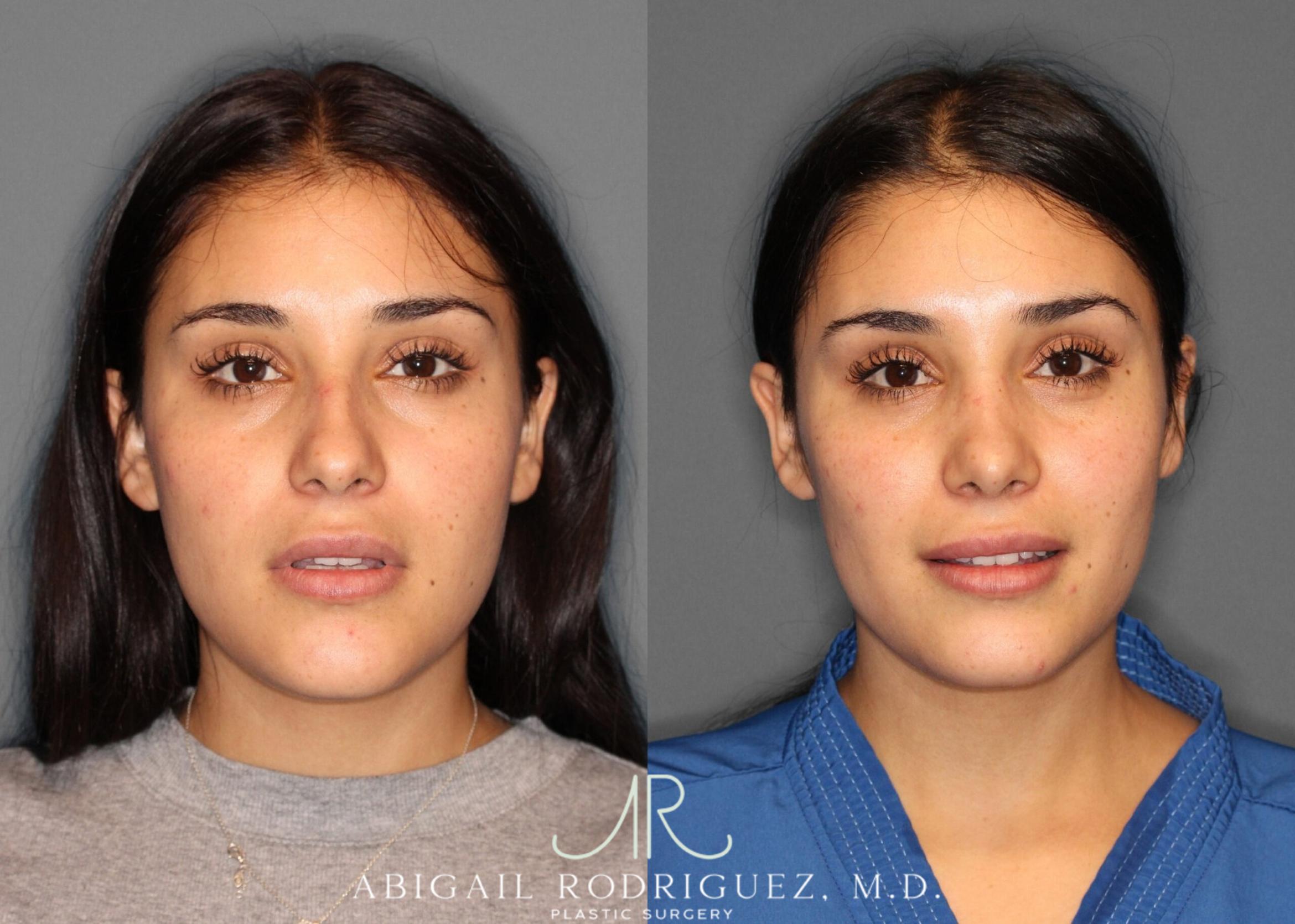 Before & After Non-Surgical Rhinoplasty Case 345992 Front View in Houston, TX