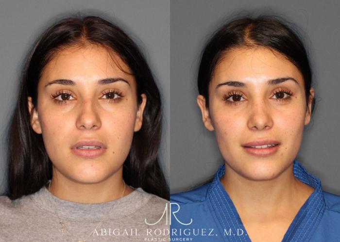 Before & After Non-Surgical Rhinoplasty Case 345992 Front View in Houston, TX