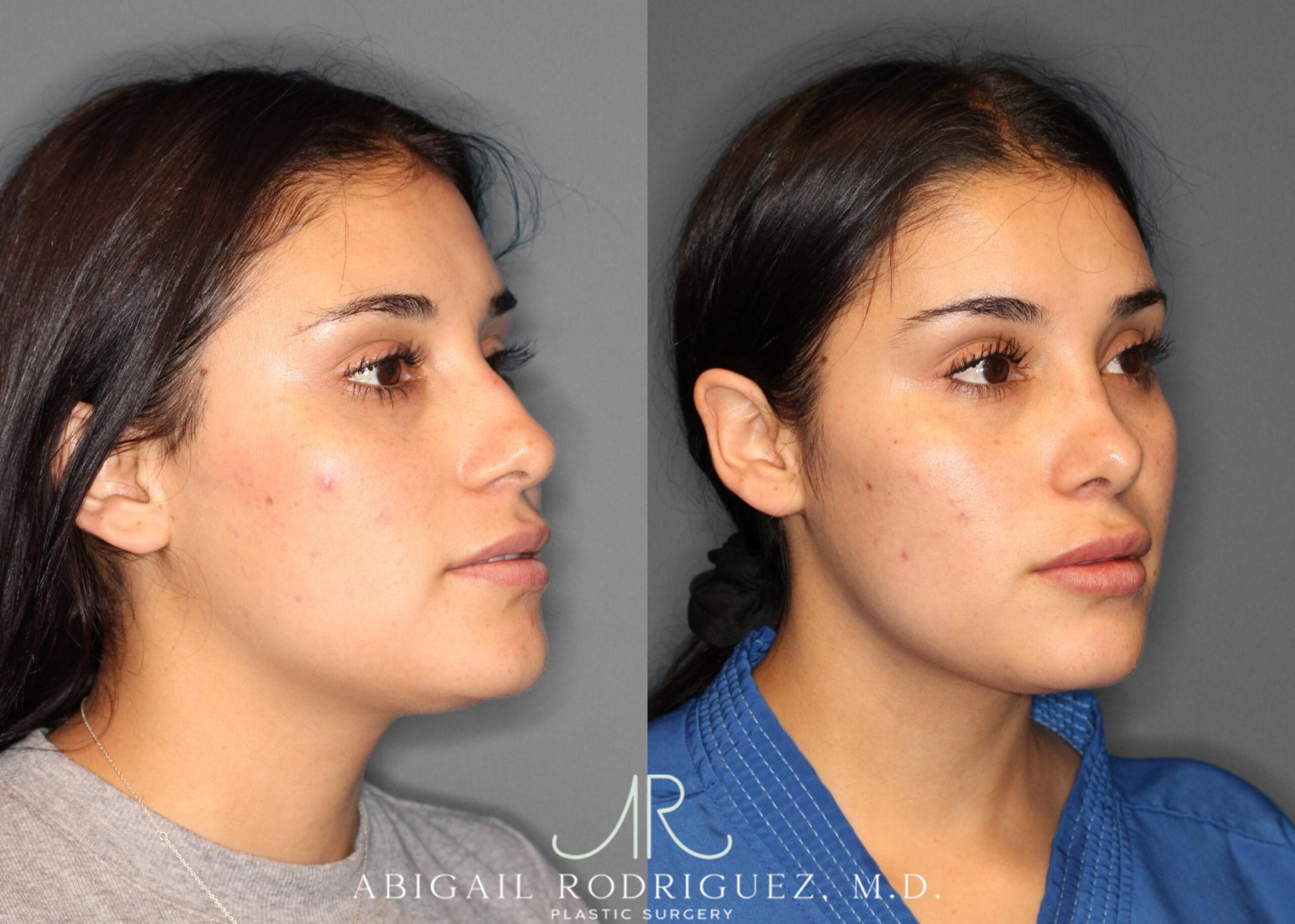 Before & After Non-Surgical Rhinoplasty Case 345992 Right Oblique View in Houston, TX