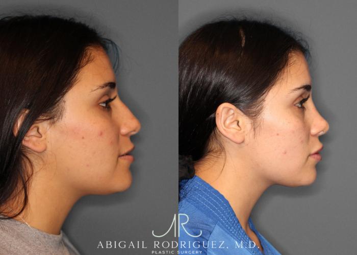 Before & After Non-Surgical Rhinoplasty Case 345992 Right Side View in Houston, TX