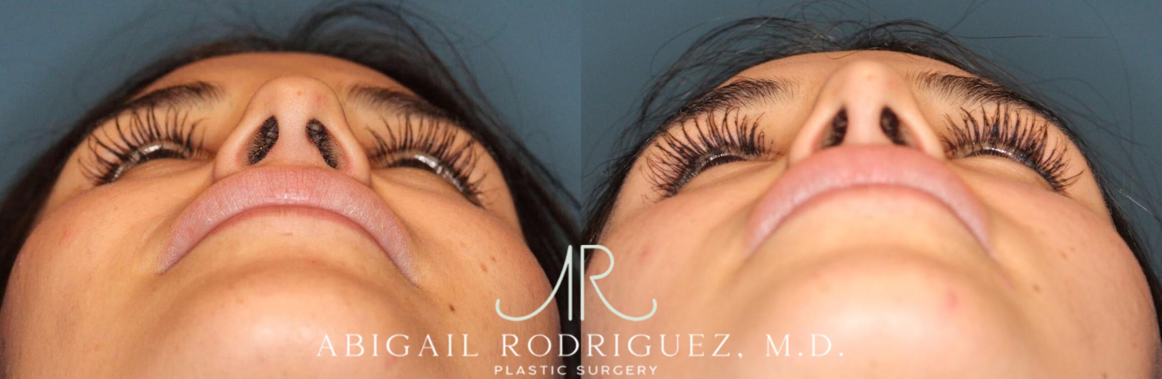 Before & After Non-Surgical Rhinoplasty Case 345992 Under  View in Houston, TX