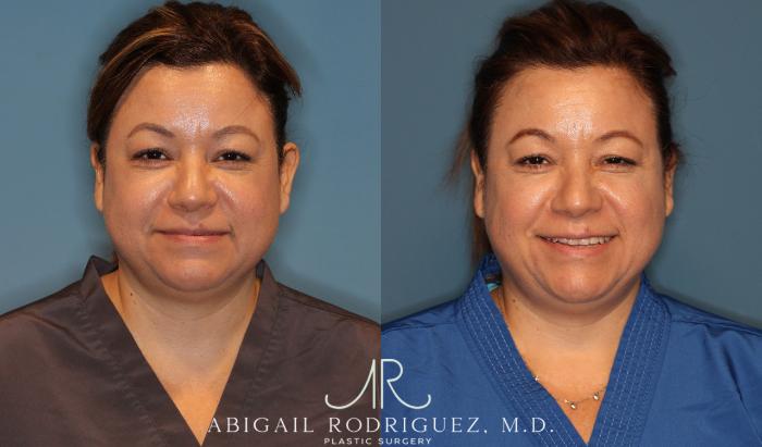 Before & After Otoplasty Case 258334 View 1 View in Houston, TX