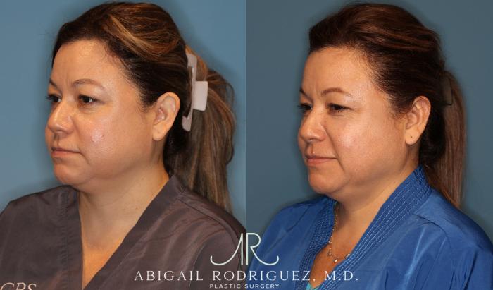 Before & After Otoplasty Case 258334 View 2 View in Houston, TX