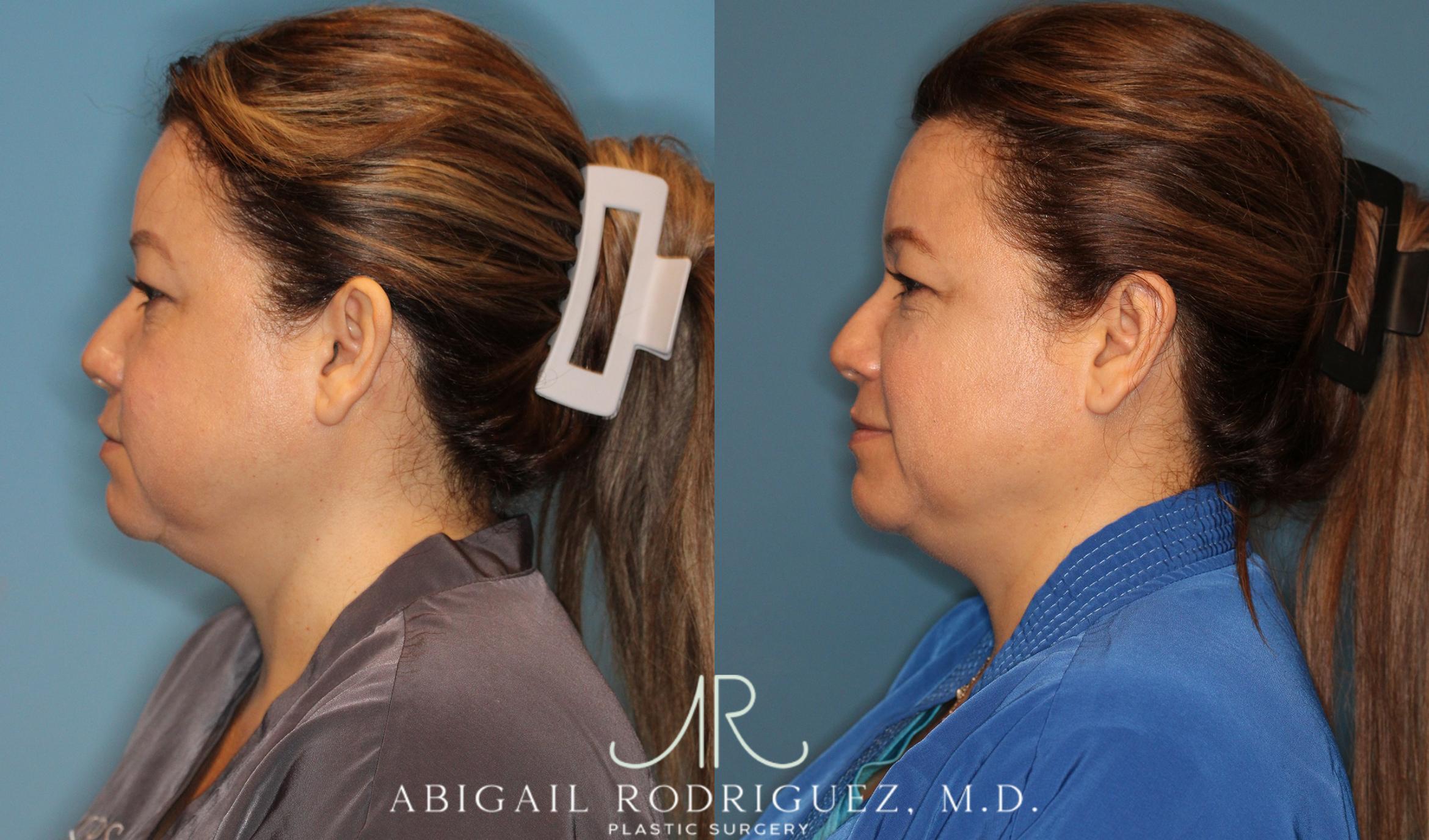 Before & After Otoplasty Case 258334 View 3 View in Houston, TX