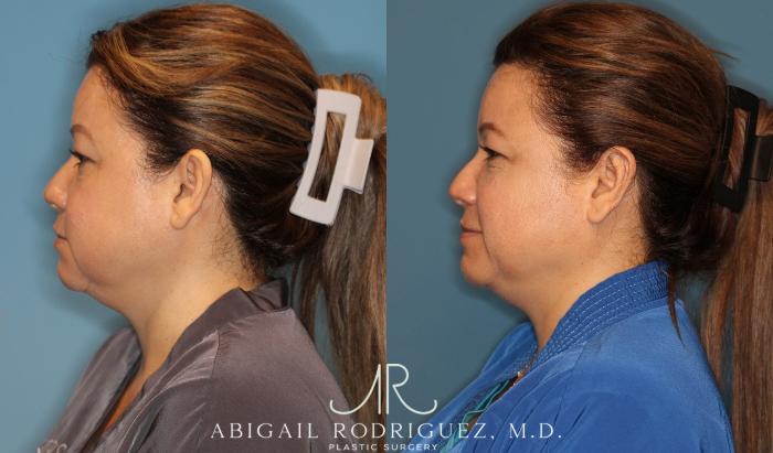 Before & After Otoplasty Case 258334 View 3 View in Houston, TX