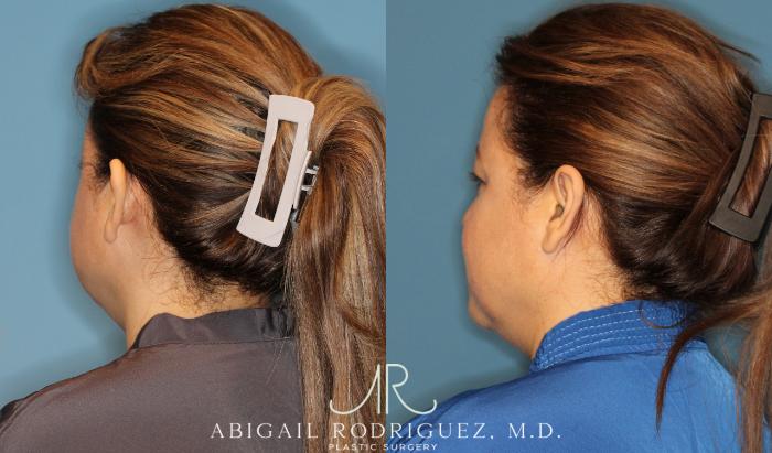 Before & After Otoplasty Case 258334 View 4 View in Houston, TX