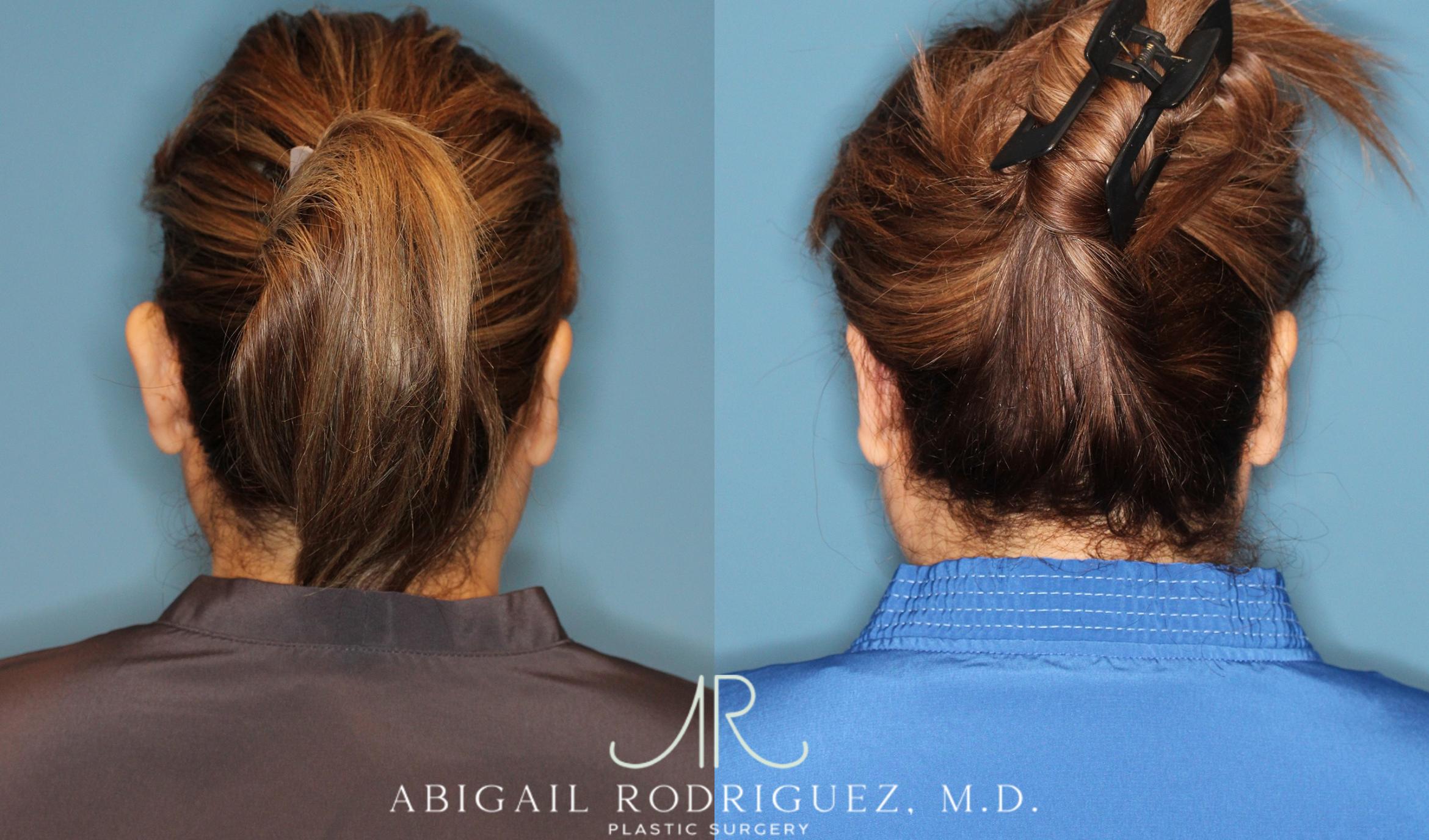 Before & After Otoplasty Case 258334 View 5 View in Houston, TX