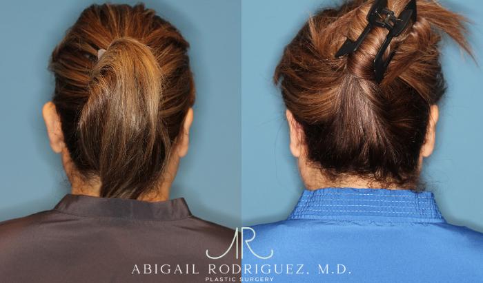 Before & After Otoplasty Case 258334 View 5 View in Houston, TX